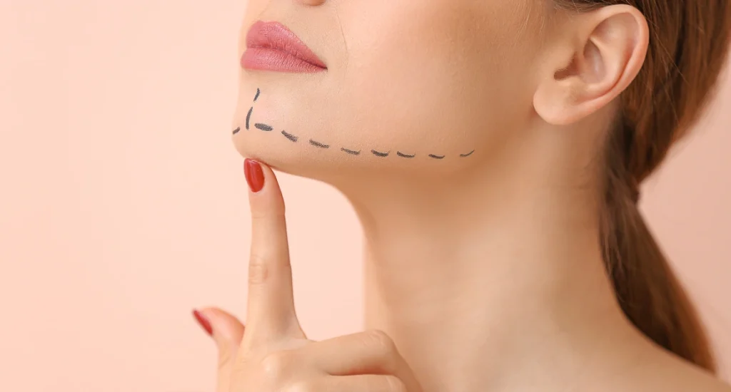 A woman’s chin and jawline marked with dotted lines, indicating preparation for plastic surgery such as chin augmentation or jawline contouring.